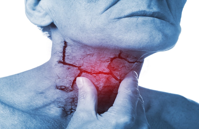 7 Causes of Strep Throat